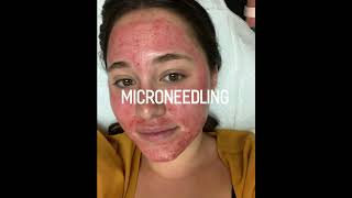 MicroNeedling  Collagen Induction Therapy [upl. by Schechter]