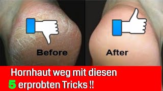 5 erprobte Tricks um extreme Hornhaut zu entfernen [upl. by Adnal]