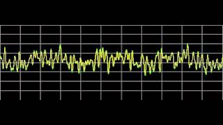 Sarcoidosis  Rife Frequencies [upl. by Ellord]