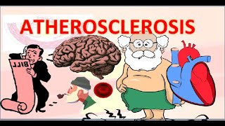 Atherosclerosis in hindi  एथेरोस्क्लेरोसिस  pathophysiology  pathogenesis [upl. by Noir]