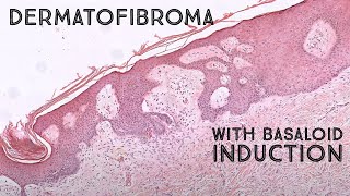 Dermatofibroma with basaloid follicular induction mimic of basal cell carcinoma pathology [upl. by Asiralc346]