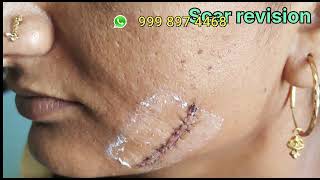 stitches scar plastic surgery in vadodara  Remove Stitch  stitches scar laser treatment [upl. by Maccarthy452]