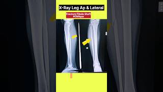 Leg Bone Fibula Ka Fracture shorts xray fracture [upl. by Eleik]