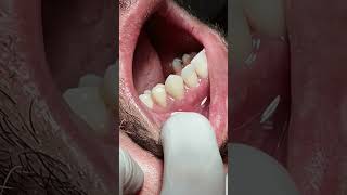 Tooth crowns after RCT satisfying [upl. by Ruelle]