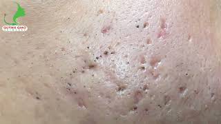 Satisfying SkinCare Blackheads Acne Extraction Video With Dr Thuy QGSPA Date Nov122024 1 [upl. by Sonia525]