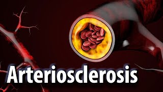 arteriosclerosis vs atherosclerosis causes symptoms and preventions [upl. by Marras161]