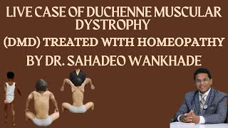 quotLive Case of Duchenne Muscular Dystrophy DMD Treated with Homeopathy BY DR SAHADEO WANKHADE [upl. by Dilly]