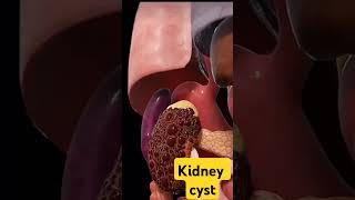 The kidney cyst neet mbbs doctor [upl. by Dennet164]