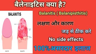 बैलेनाइटिस  Balanitis Best Treatment of Balanitis  cause ✅ Best Homeopathic Doctor in India ✅ [upl. by Adonis]