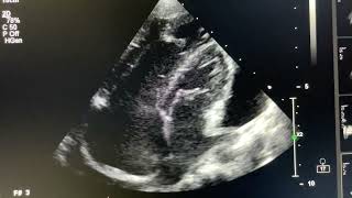 Moderate Pericardial Effusion with Sinus Venosus ASD SVC type [upl. by Kella819]