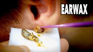 THE BEST EARWAX REMOVAL EVER and most gross  Dr Paul [upl. by Francisco]