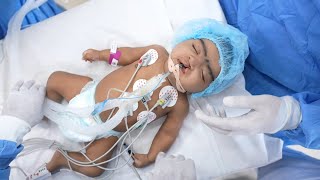 Cleft Lip Baby Intubation by pediatric anesthesiologist for cleft lip surgery [upl. by Rinna]