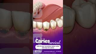 🦷 CARIES CERVICAL todo lo que necesitas saber sobre este tipo de caries [upl. by Norraf]