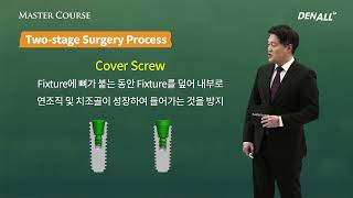 Master Course  BASIC ep 12 One stage Surgery amp Two stage Surgery Indication and Feature [upl. by Cullin872]