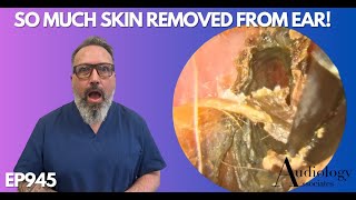 SO MUCH SKIN REMOVED FROM PATIENTS EAR CANAL  EP945 [upl. by Airetahs]