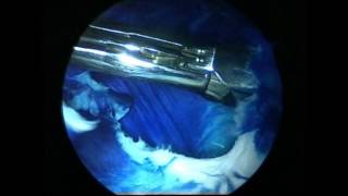 Arthroscopic Baker Cyst resection of the knee demo by DrBancha Chernchujit Thammasat University [upl. by Ifok]