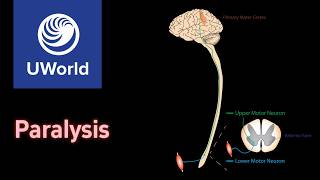 Vertebral malalignment amp Subluxation atlantoaxial joint  USMLE Step 1 UWorld Questions Neurology [upl. by Landers]