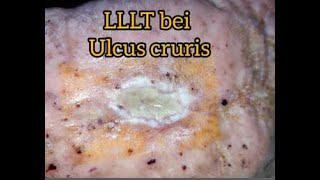 Ulcus Cruris Behandlung mit LLLT  HELBO Minilaser 3120 Anleitung Ulcus mit Laser behandeln [upl. by Adalia]