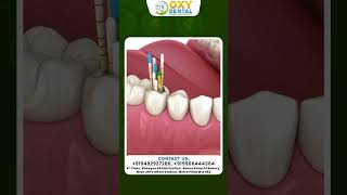 Root Canal Treatment  Treatment  Root Canal Recovery  Oxy Dental [upl. by Erait]