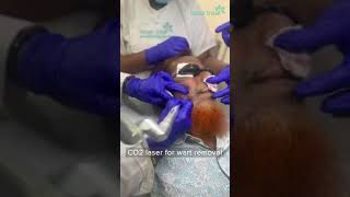 CO2 Laser  Wart Removal  Dhaka Dermatology Institute  LaserTreat [upl. by Paule242]