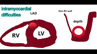 LIMA  LITA Angle of Anastomosis and Long Term Patency [upl. by Aramaj]