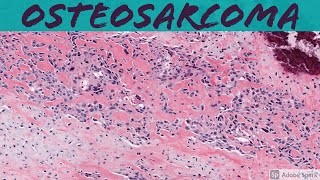 Osteosarcoma 101 Bone Pathology Basics [upl. by Dinerman]