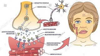 Myasthenia Gravis  the effects [upl. by Sonitnatsnoc694]