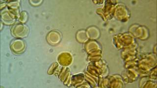 SPIROCHETES  coming out of a WBC [upl. by Adnilahs]