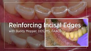 Reinforcing Incisal Edges [upl. by Chessa]