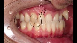 Reverse Overjet Correction with Simple Orthodontics Before Veneers [upl. by Alyaj]