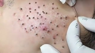 Best Pimple Removal  The best Video [upl. by Isma]