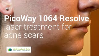 PicoWay 1064 Resolve for Acne scars Treatment 2 [upl. by Haleeuqa]