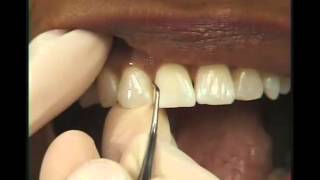 Periodoncia  Raspado [upl. by Nivan11]