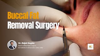 Buccal Fat Removal Surgery  Cheek Fat Reduction  Face slimming Dr Rajat Gupta  RG Aesthetics [upl. by Nivaj]