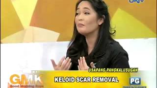 Keloid Scar Removal [upl. by Soinski103]