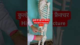 कुल्हे की हड्डी का फ्रैक्चर  Hip Joint Fracture  Femur Bone shorts viral youtubeshorts [upl. by Nyliac8]