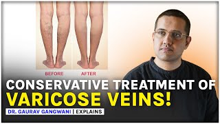 Varicose Veins Treatment Without Any Surgery  Dr Gaurav Gangwani Interventional Radiologist [upl. by Case]