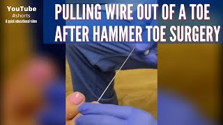 Pulling a kWire out of a toe after hammer toe surgery  shorts [upl. by Baelbeer]