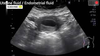 Uterine fluid I Endometrial fluid I Minimal fluid collection in uterine cavity [upl. by Garling]