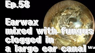 ep58 Severe earwax removal [upl. by Oisor]