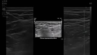 Parathyroid Lesion in the Thymic Remnant radiology ultrasound endocrinegland tumour [upl. by Shara723]