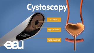 Cystoscopy overactive bladder [upl. by Anekam]