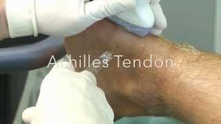 OSTENIL® Tendon injection 14 Achilles Tendon [upl. by Afatsum]