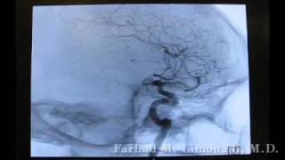 3D Cerebral Angiography [upl. by Gussi]