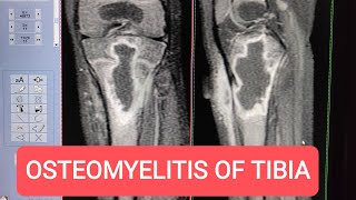 MRI of Tibia with Contrast  Diagnosing Osteomyelitis on GE 15 Tesla [upl. by Twila]