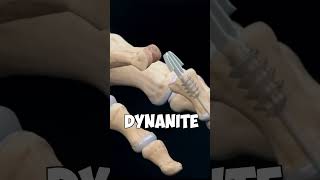 Hammer Toe Surgery Transformed with DynaNite PIPJ Implant A LifeChanging Procedure [upl. by Plank]