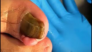 Big Ingrown Toenail and Pedicure Removal Treatment  TOENAIL ROOMB Live Stream [upl. by Notnerb]