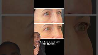 The best treatment to treat aging eyes [upl. by Hound307]