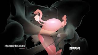 How Is A Robotic Hysterectomy Done  Robotic Hysterectomy Surgery  Gynaecology  Manipal Hospitals [upl. by Scrivenor]