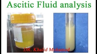 Ascitic fluid analysis تحليل السائل البريتوني [upl. by Goles]